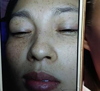 中药皮膜祛斑,根除雀斑,招加盟商分享的小视频